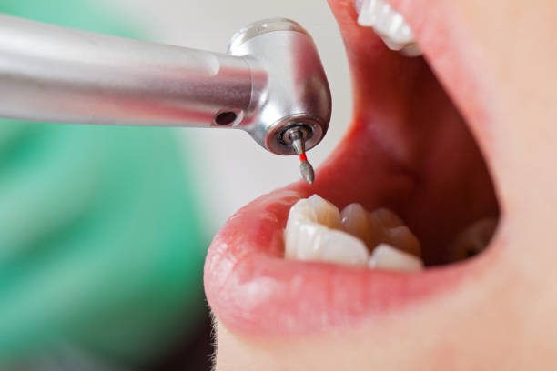Best Lost Filling or Crown Replacement in Bronxville, NY